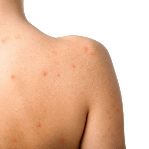 Acne Back Laser Treatment