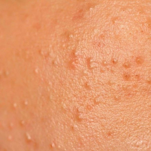 Acne Buttocks