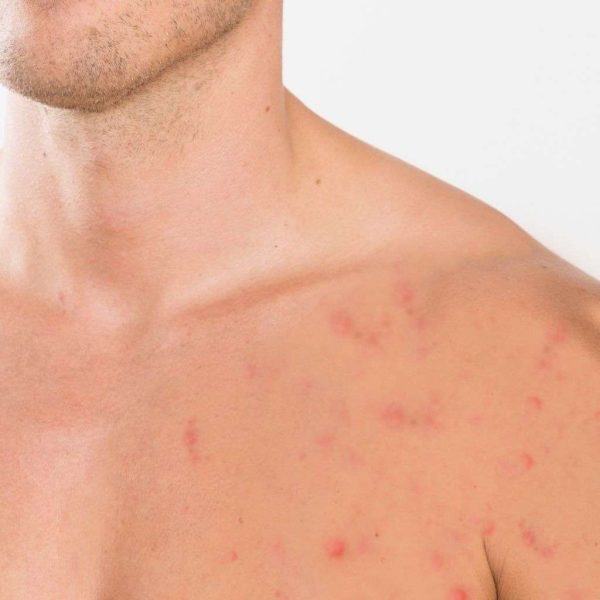 Acne Chest laser treatment