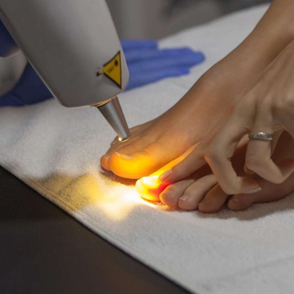Advanced laser treatment for fungal nail infections