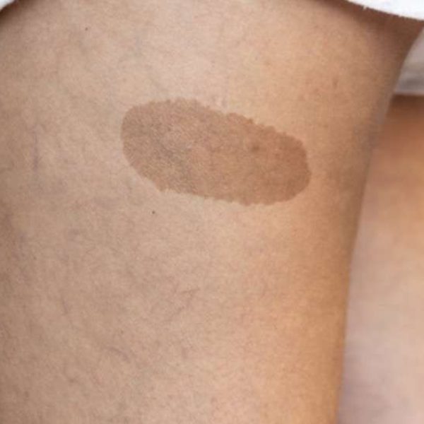 Advanced laser treatment for pigmented birthmarks in Bradford