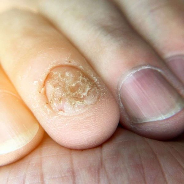 Fungal Nails