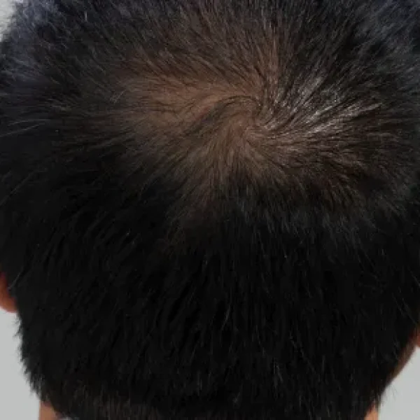 Hair Restoration