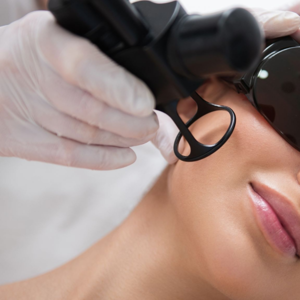 Melasma Laser treatment in Bradford 