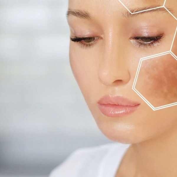 PICO laser treatment for pigmentation in Bradford 