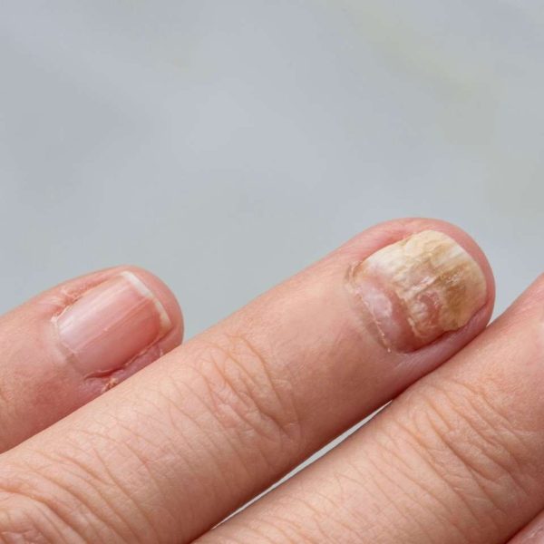 Picosecond laser treatment for fungal toenails at Arden Clinic Bradford