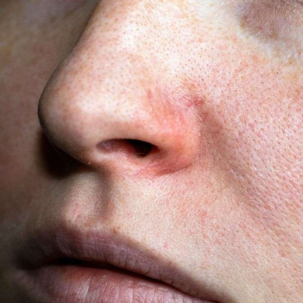 Veins Medium Area