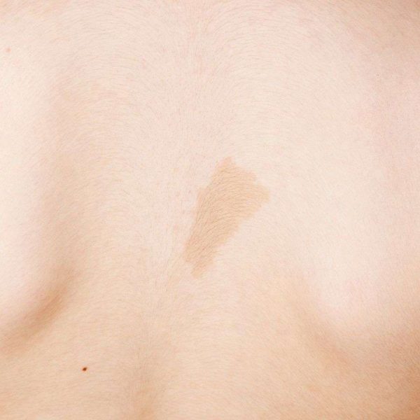 medium birth mark removal
